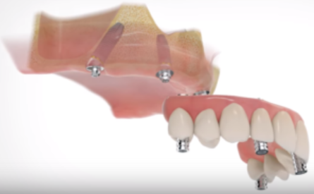 All On Four Dental Implants Long Island business image in Patchogue, NEW YORK